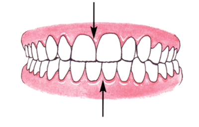 diagram showing what Dental Midlines Not Matched looks like