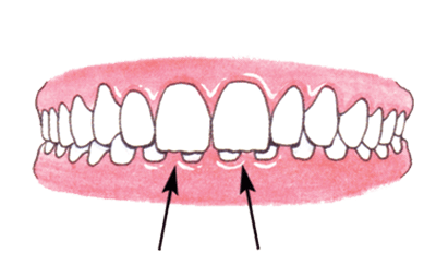 diagram showing what Overbite looks like