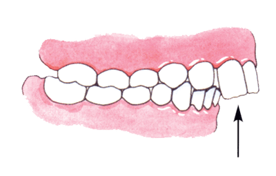 diagram showing what Protrusion of Upper Front Teeth looks like