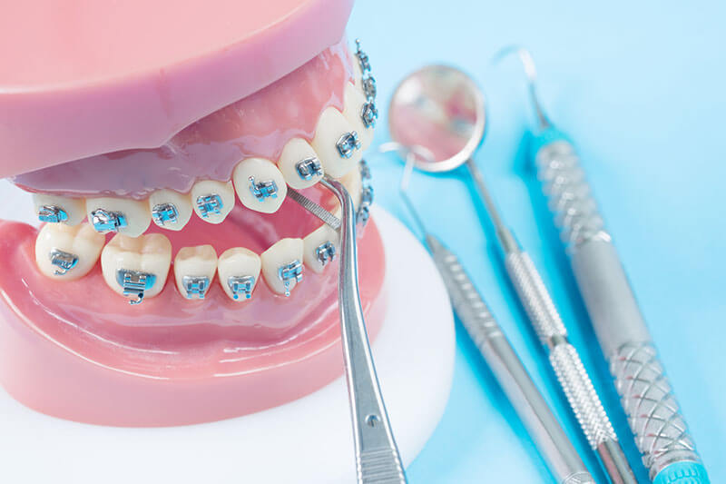 demo braces on a set of plaster teeth by dental instruments